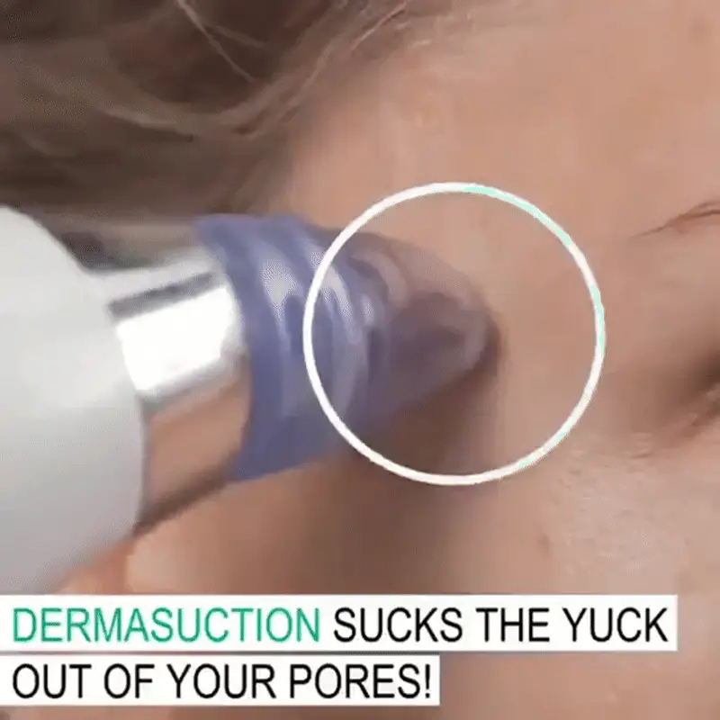 blackhead remover blackhead remover