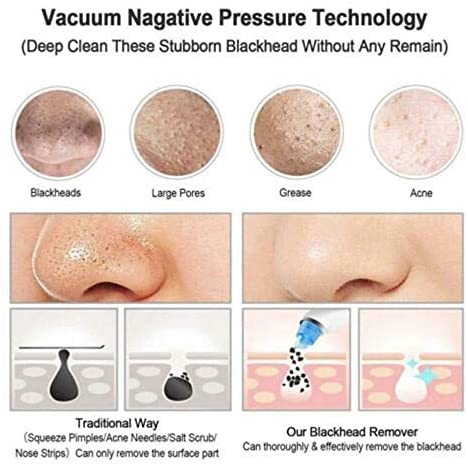 blackhead remover blackhead remover